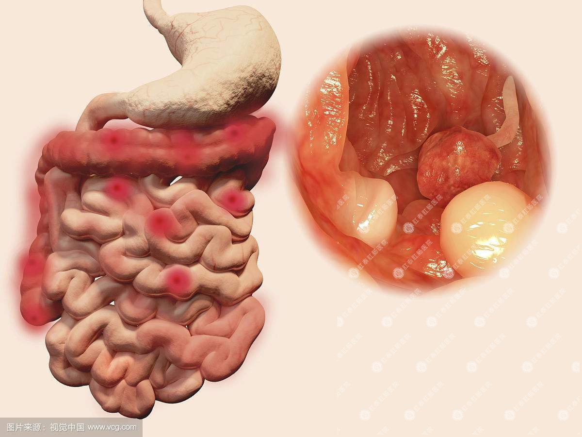 泉州治疗溃疡性结肠炎哪家医院比较好